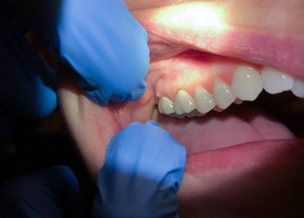 Tooth Infection Emergency Dentist in TX